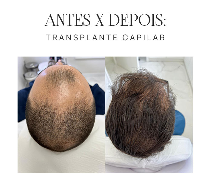 Transplante Capilar