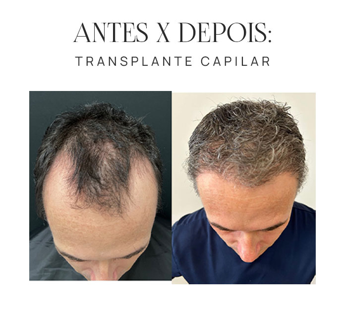 Transplante Capilar