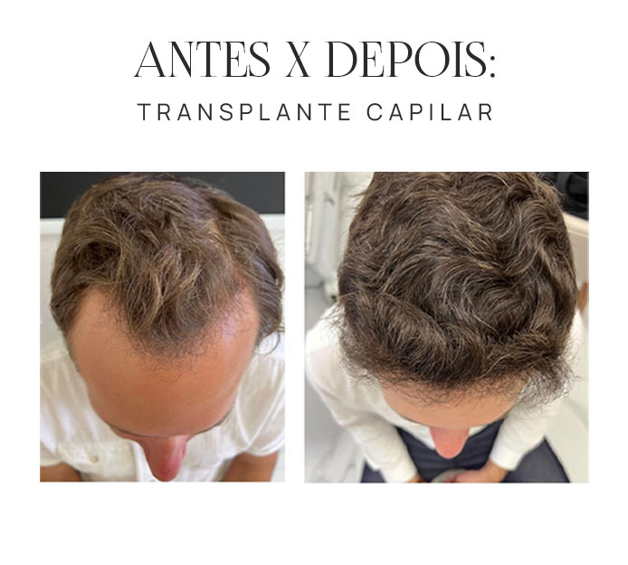 Transplante Capilar