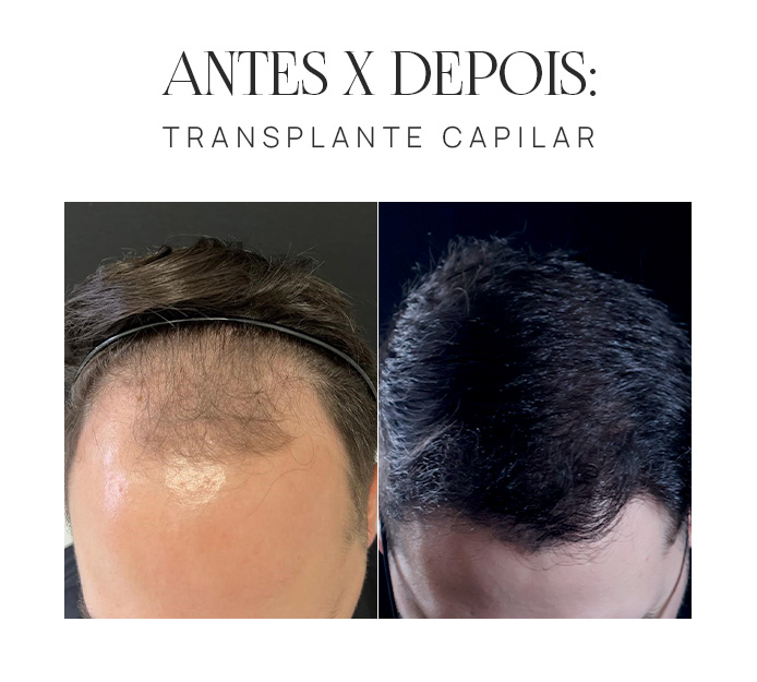 Transplante Capilar